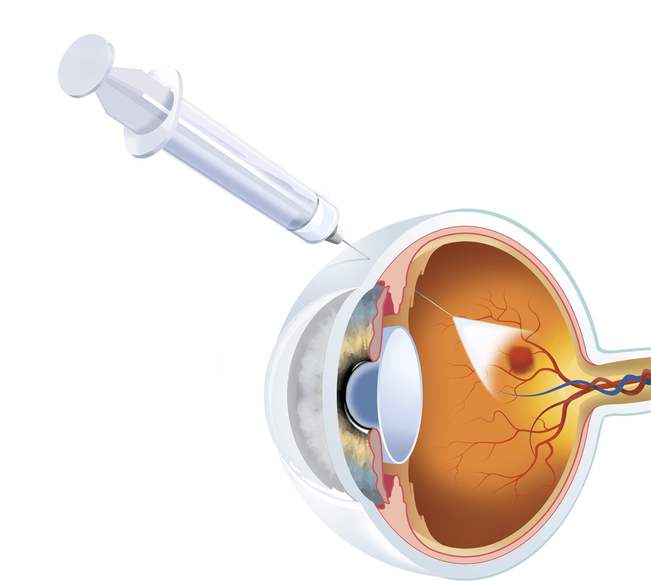 Inyección Intravítrea